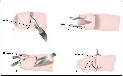 Phương pháp cắt bao quy đầu bằng dao điện